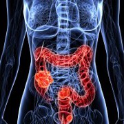 Colon Cancer related image